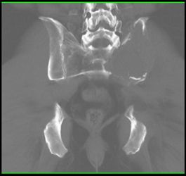 Metastatic Renal Cell Carcinoma - CTisus CT Scan