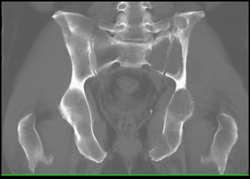 Metastatic Renal Cell Carcinoma - CTisus CT Scan