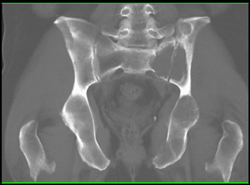 Metastatic Renal Cell Carcinoma - CTisus CT Scan