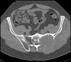 Metastatic Renal Cell Carcinoma - CTisus CT Scan