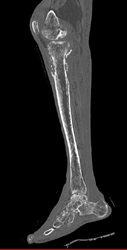 Stress Fracture - CTisus CT Scan