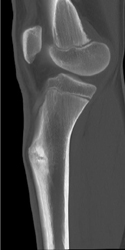 Stress Fracture - CTisus CT Scan