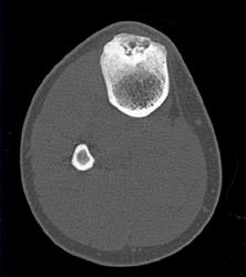 Stress Fracture - CTisus CT Scan