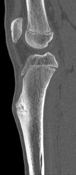 Stress Fracture - CTisus CT Scan