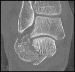 Calcaneal Fracture - CTisus CT Scan