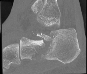 Calcaneal Fracture - CTisus CT Scan