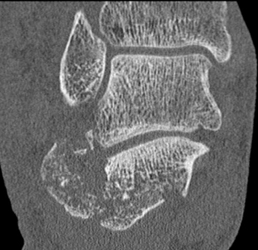 Calcaneal Fracture - CTisus CT Scan