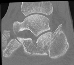 Calcaneal Fracture - CTisus CT Scan