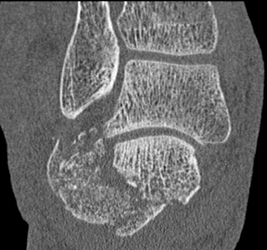 Calcaneal Fracture - CTisus CT Scan