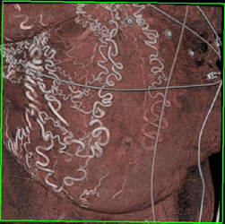 Collaterals in Abdominal Wall - CTisus CT Scan