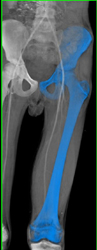 Normal CTA - CTisus CT Scan