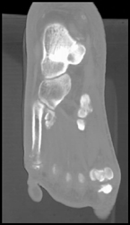 Ulceration and Cellulitis - CTisus CT Scan