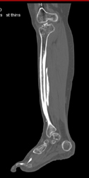 Tibial Bowing - CTisus CT Scan