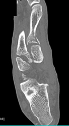 Metatarsal Fracture - CTisus CT Scan