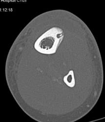 Osteoid Osteoma - CTisus CT Scan