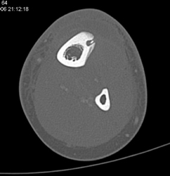 Osteoid Osteoma - CTisus CT Scan