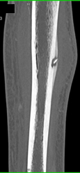 Osteoid Osteoma - CTisus CT Scan