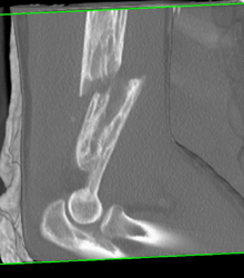 Fracture Through Paget's Bone - CTisus CT Scan