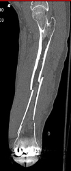 Femur Fracture - CTisus CT Scan