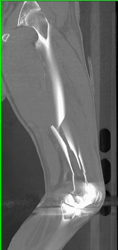 Femur Fracture - CTisus CT Scan