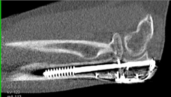 Screw Through Ulna - CTisus CT Scan