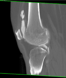 Knee Arthrogram - CTisus CT Scan