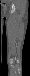 Exostosis - CTisus CT Scan