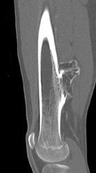 Exostosis - CTisus CT Scan