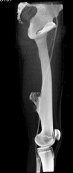 Exostosis - CTisus CT Scan