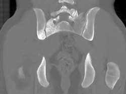 Bone Involvement By Lymphoma-see Soft Tissue Mass - CTisus CT Scan