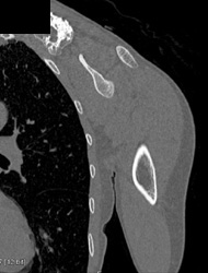 Osteochondroma Off the Scapula - CTisus CT Scan