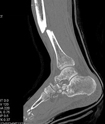 Calcaneal Fractures - CTisus CT Scan