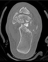 Complex Tibial/fibular Fractures - CTisus CT Scan