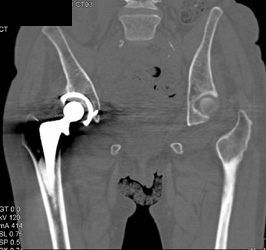 3D of Total Hip Replacement (THR) With Metal Reduction - CTisus CT Scan