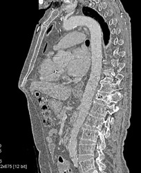 Collapsed T-spine Vertebral Bodies - CTisus CT Scan