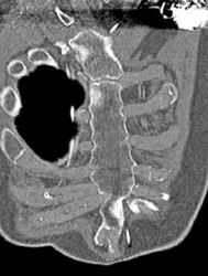 Subtle Sternal Fractures - CTisus CT Scan