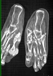 Gout - CTisus CT Scan