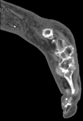 Gout - CTisus CT Scan