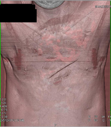 Prior Failed Pectus Repair - CTisus CT Scan