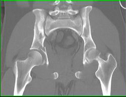 Acetabular Fracture - CTisus CT Scan