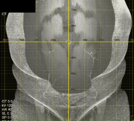 DIEP Flap Study - CTisus CT Scan