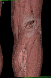 CTA Status Post Gunshot Wound - CTisus CT Scan