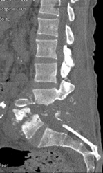 Osteomyelitis and Failed Repair - CTisus CT Scan