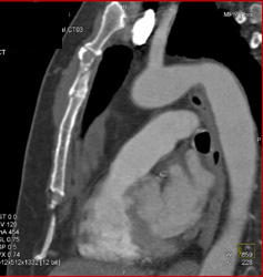 Sternal Fractures - CTisus CT Scan