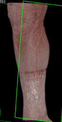 Skin Ulcers With Tumor - CTisus CT Scan