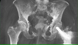 Stress Fracture - CTisus CT Scan