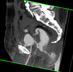 Radiation Osteitis and Colovesical Fistulae - CTisus CT Scan