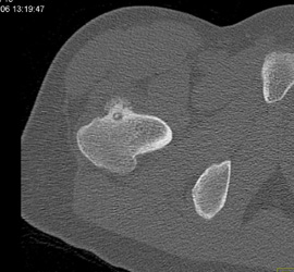 Osteoid Osteoma - CTisus CT Scan