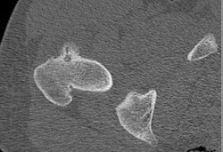 Osteoid Osteoma - CTisus CT Scan