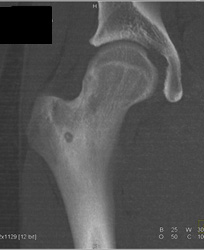 Osteoid Osteoma - CTisus CT Scan